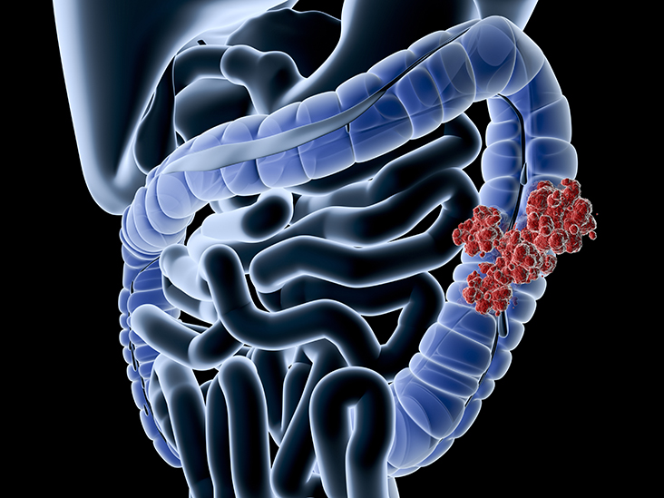 Colorectal Colon